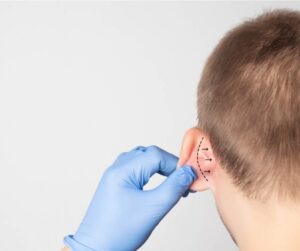 plastic surgeon doctor examines a male patient s ear for an otoplasty picture id1205284865