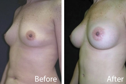 before and after breast implants massachusetts
