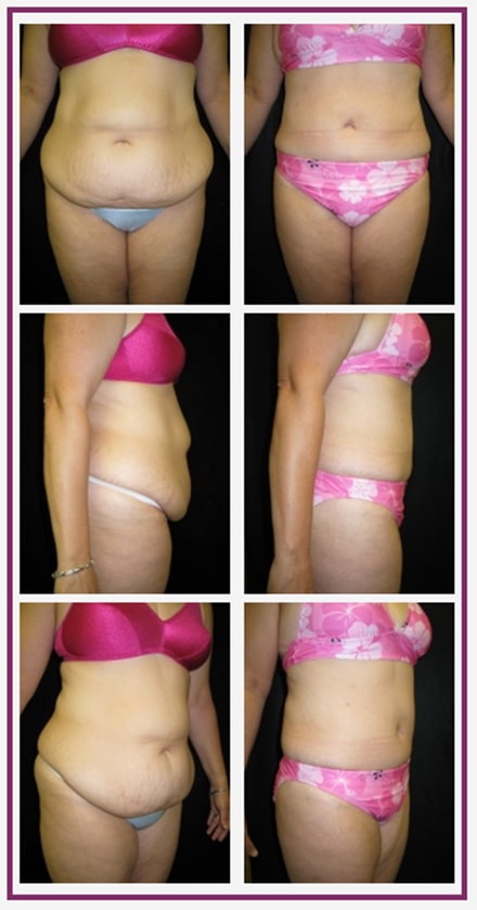 Boston Tummy Tuck Patient
