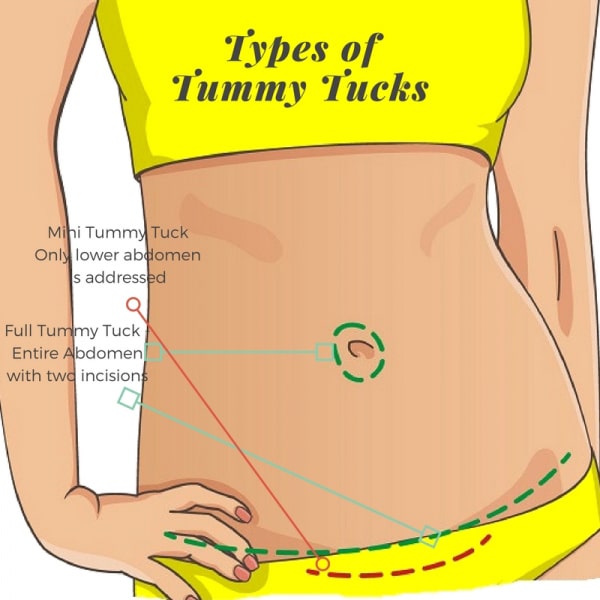 Types of Abdominoplasty Tummy Tucks | Dr Chatson in Boston