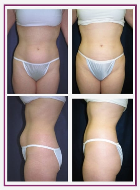 Body Contouring for Women in the Boston Area | Dr Chatson