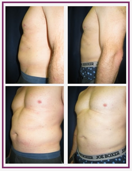 Body Contouring for Men in the Boston Area | Dr Chatson