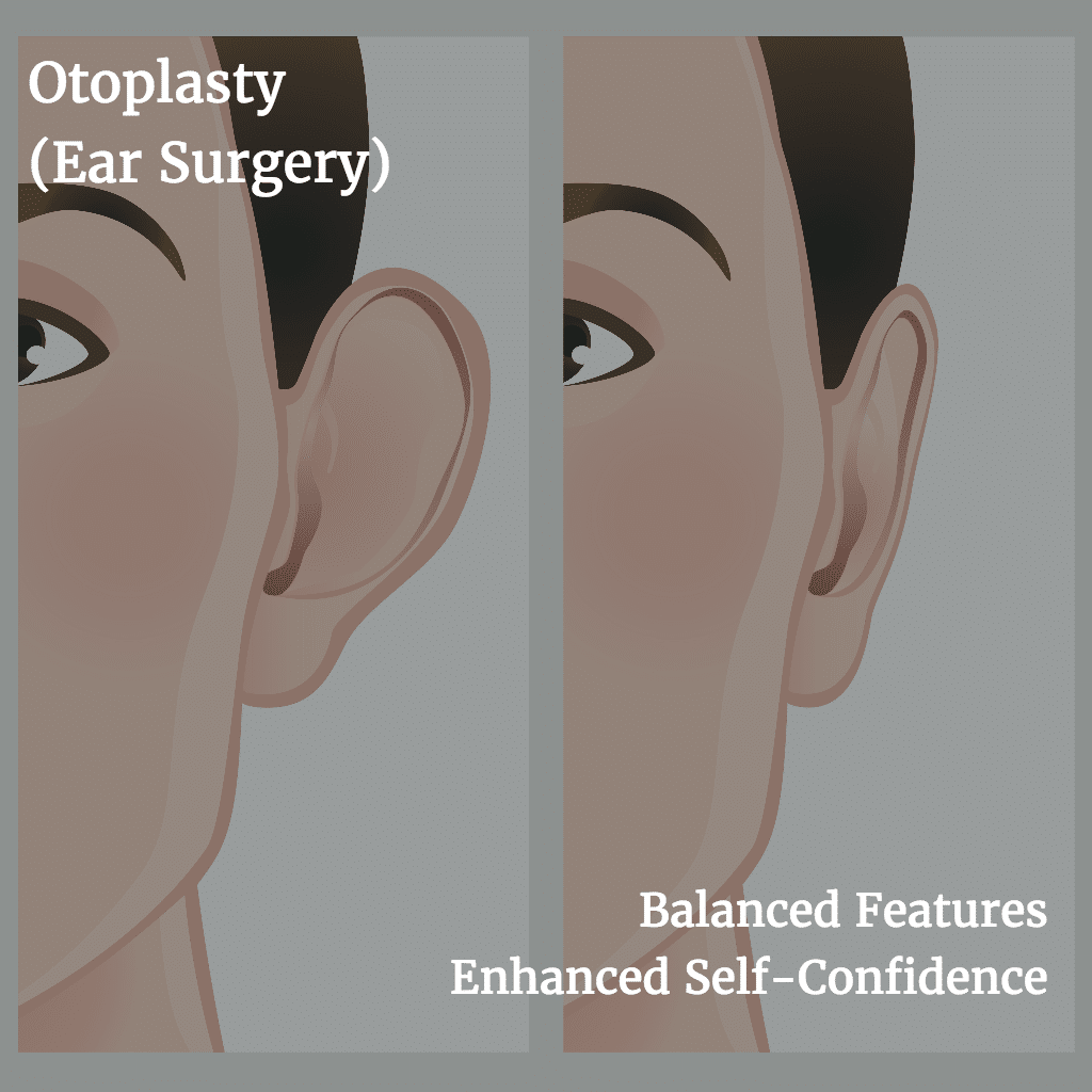 Otoplasty