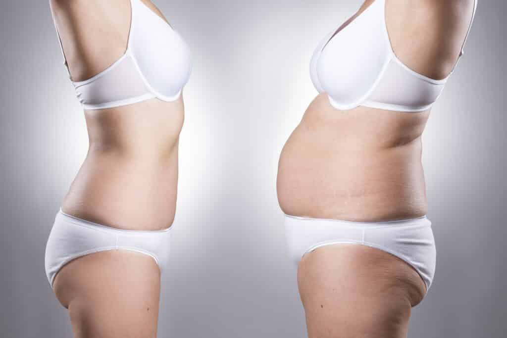 Can Tummy Tuck Surgery be Covered by Insurance? 647a1c8684a01.jpeg