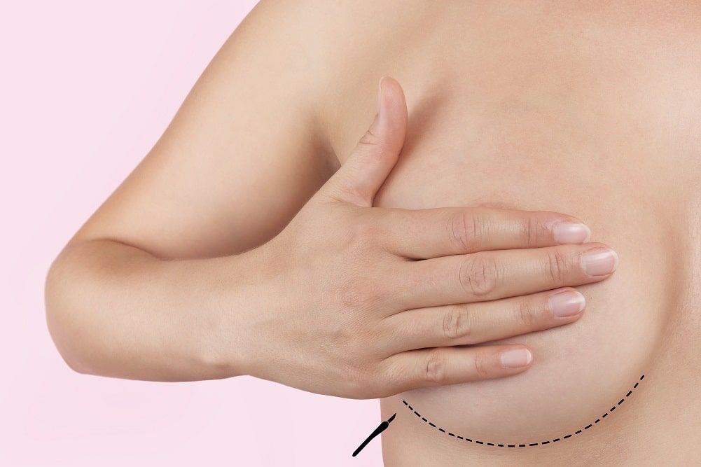 Breast Augmentation Scars | Salem & Nashua, NS