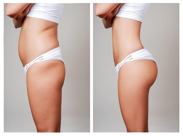 Four Reasons to Consider a Brazilian Butt Lift 647a158485086.jpeg