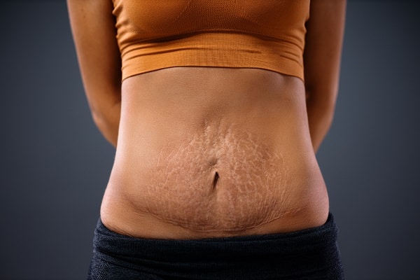 Abdomen of Woman with Loose Skin and Stretch Marks