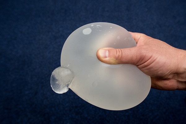 Ruptured Breast Implant