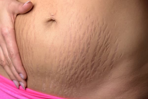 Woman's belly with stretch marks