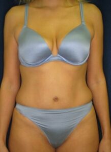 Abdominoplasty 1