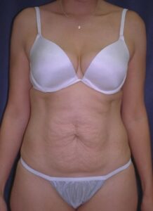 Abdominoplasty 1