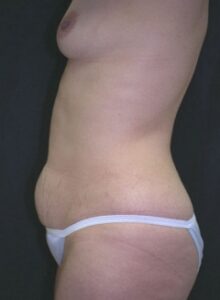 Abdominoplasty 2