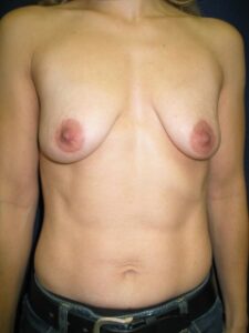 Mastopexy/Breast 2