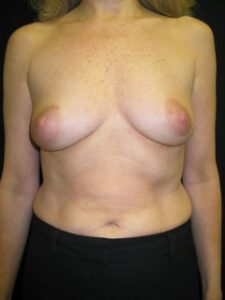 Mastopexy/Breast 3