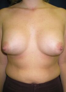 Breast Aug 1