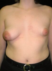 Breast Asymmetry 1