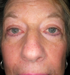 Blepharoplasty 1