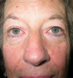 Blepharoplasty 1