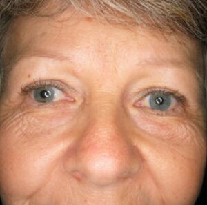 Blepharoplasty 2