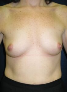 Breast Aug 2