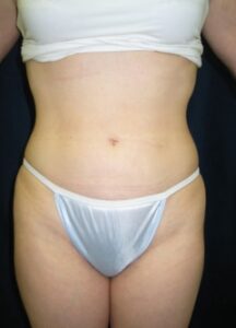 Liposuction 2