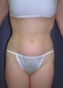 Liposuction 2