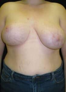 Breast Asymmetry 2