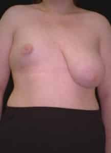 Breast Asymmetry 2