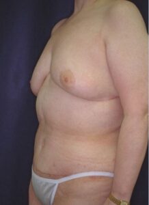 Abdominoplasty 3