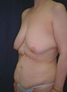 Abdominoplasty 3