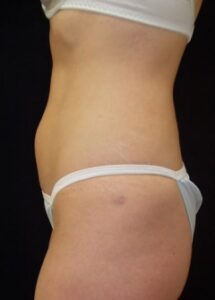 Liposuction 1